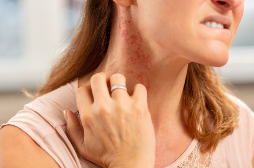 Allergy Natural Healing Remedies